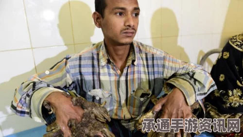 孟加拉树人手术成功，巧妙切除右手树根的技巧与方法（附图解）