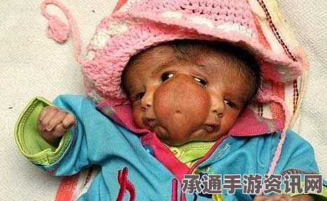 印度女婴罕见出生缺陷，半颗头颅与凸出双眼，医学界如何应对与公众关注（含附图）