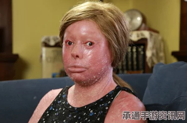 女子患罕见皮肤病引发昼夜颠倒生活挑战，应对与逆境探索