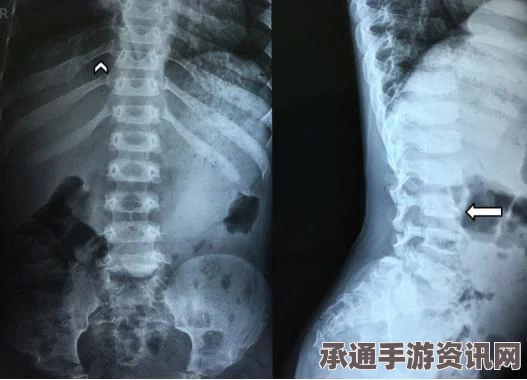 审美趋势下的身体重塑，女子肋骨手术改造探讨